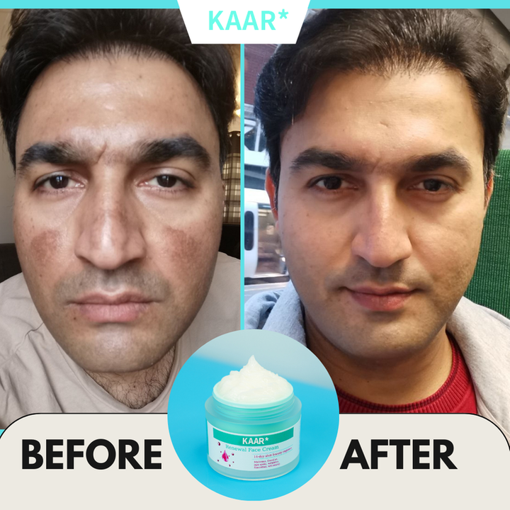 KAAR Renewing Cream — Fade Stubborn Spots in 14 Days · Sale Ends Today